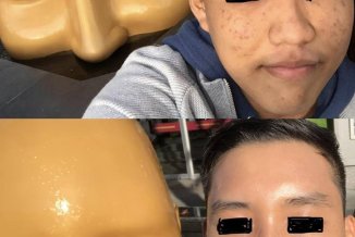 Từ da đầy mụn thành căng mọng mướt mát: bên cạnh chu trình dưỡng, anh chàng này còn phải từ bỏ một t